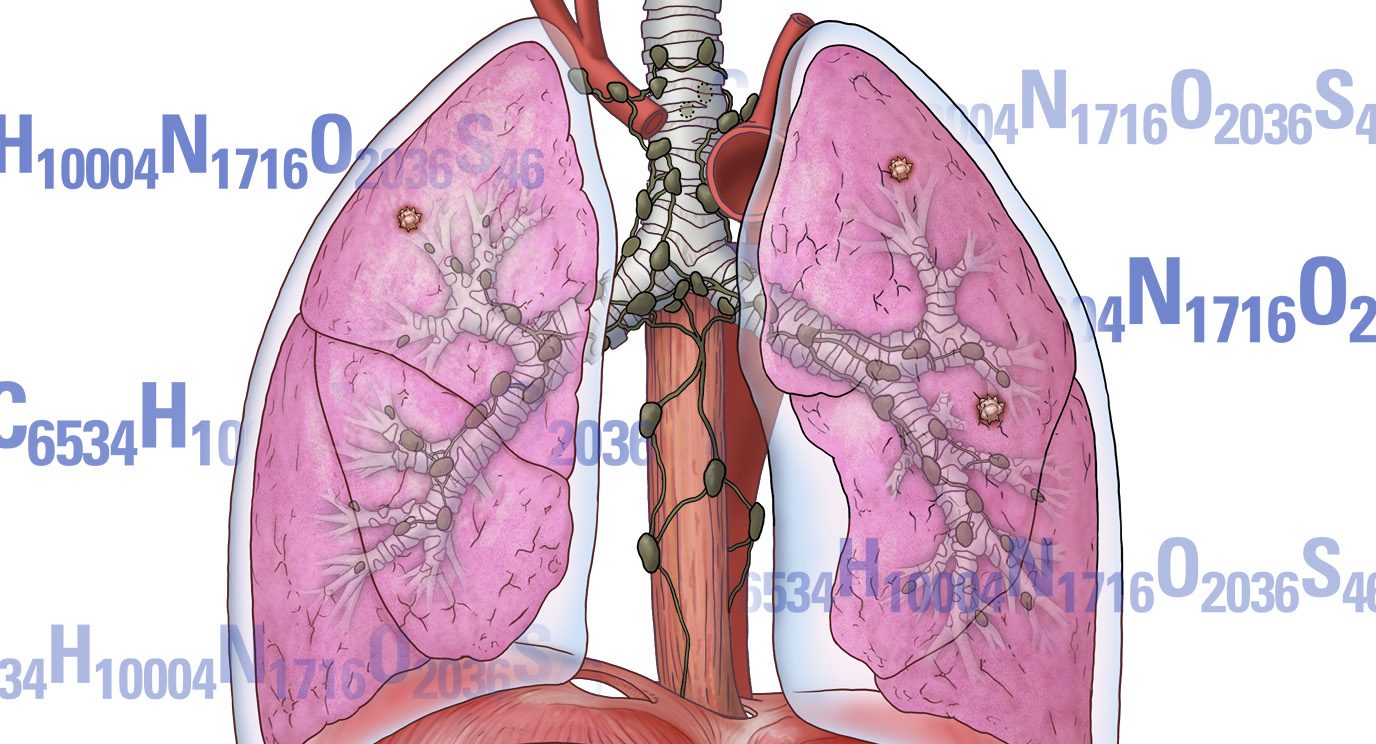 免疫疗法的临床试验使用对癌前生长的免疫检查点封锁药物pembrolizumab以防止其演变肺癌。